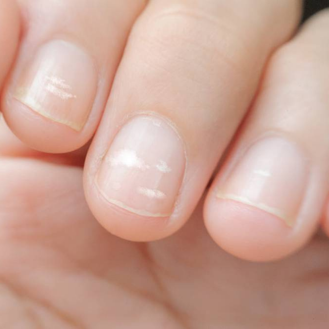 ¿Manchas blancas en las uñas? Te contamos las causas